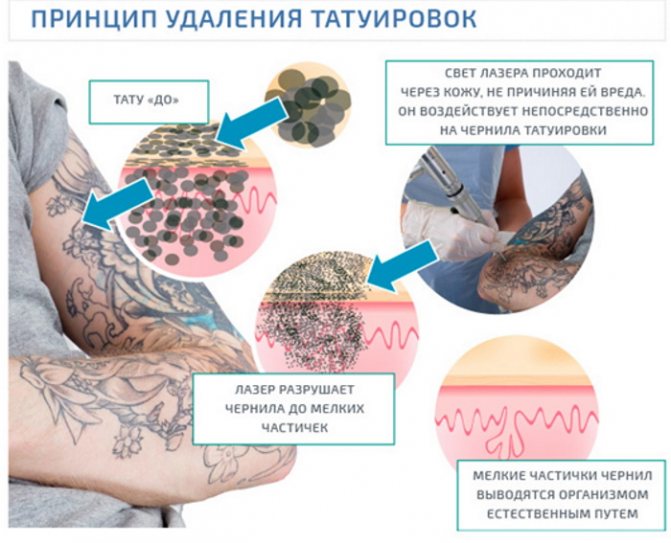 How to get rid of a tattoo, removing tattoos at home
