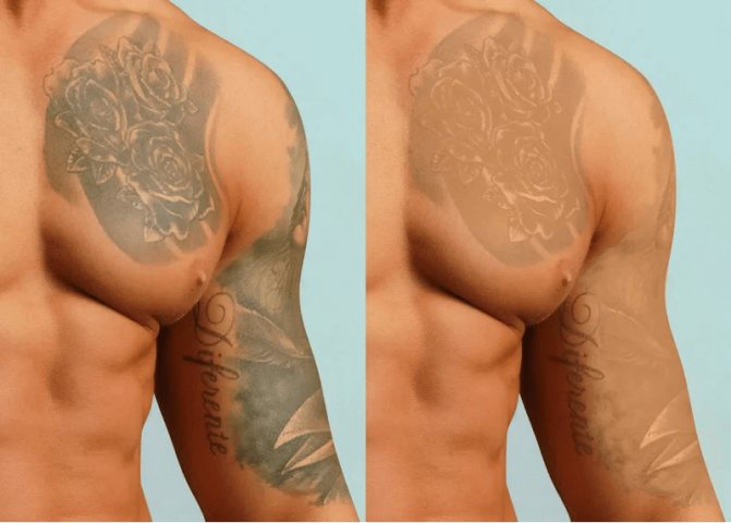 Which tattoo is easier to remove