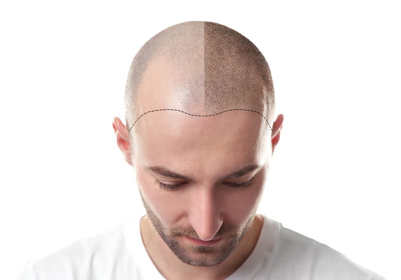 the cost of trichopigmentation to conceal baldness