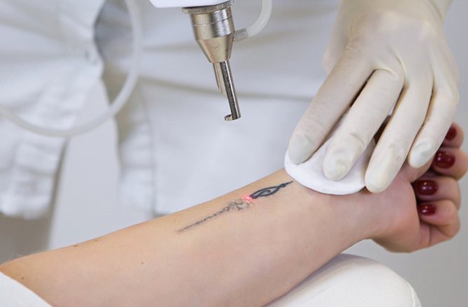 Tattoo laser review