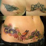 Tattoo to hide stitches on the stomach after cesarean section