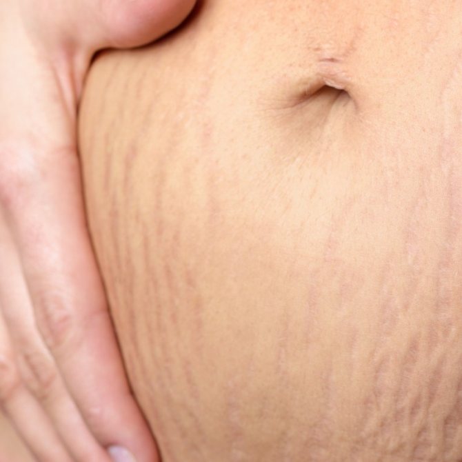 Stretch marks on the abdomen after childbirth