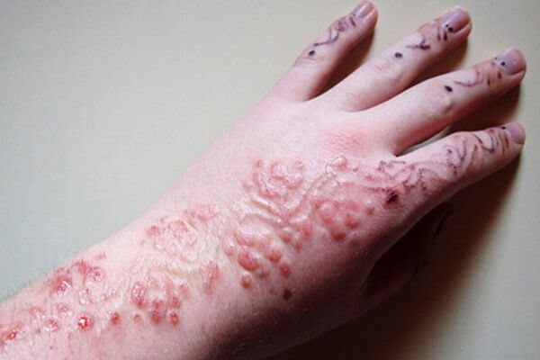 Possible complications of henna tattooing